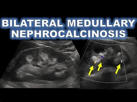 MEDULLARY NEPHROCALCINOSIS ON ULTRASOUND - YouTube