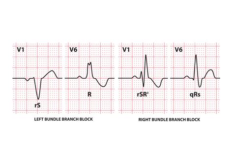 Bundle Branch Block