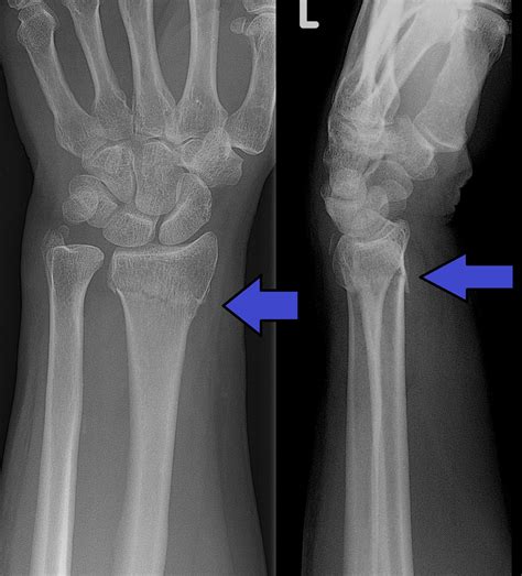 橈骨遠端骨折 Distal Radius Fracture: 最新的百科全書、新聞、評論和研究