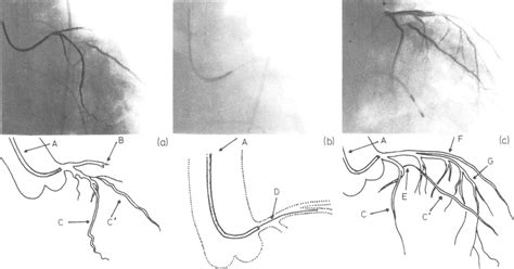 A, Coronary angiography catheter in the ascending aorta, its tip in the ...