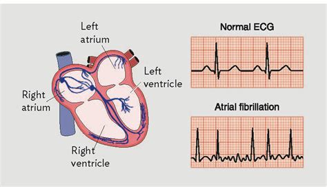 Step by step approach to Afib with RVR — Kwak Talk