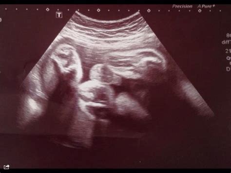 30 Weeks Pregnant Ultrasound Boy