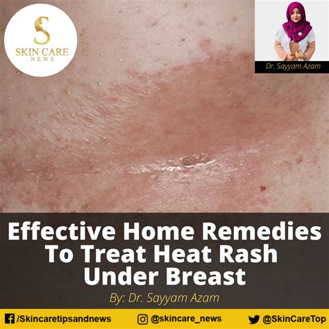 Effective Home Remedies To Treat Heat Rash Under Breast