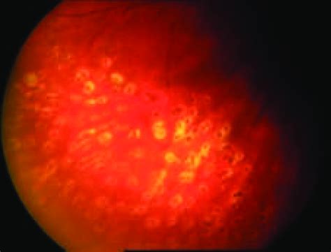 Eye fundus photography showing laser photocoagulation. | Download ...