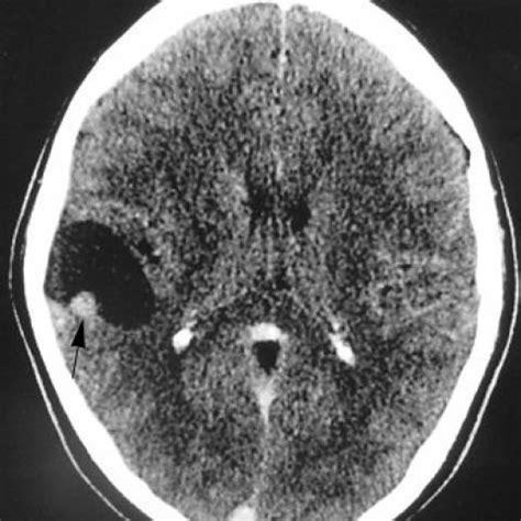 Pleomorphic xanthoastrocytoma | Eurorad