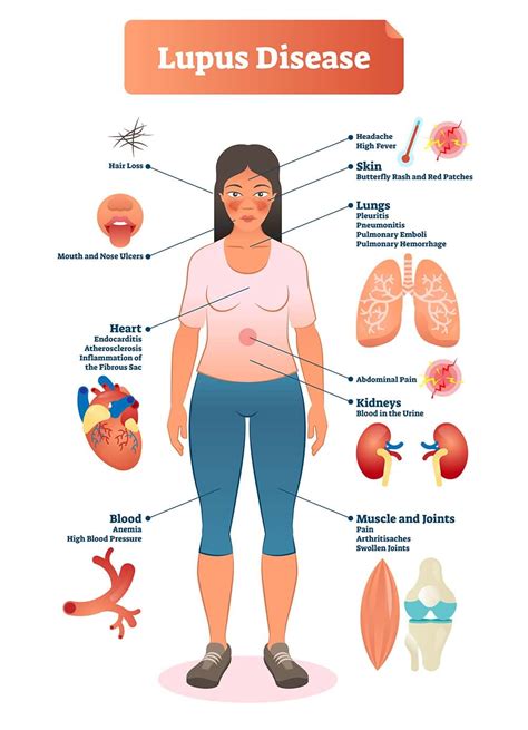 Lupus Symptoms; 10 Warning Signs and Symptoms of Lupus - Healthella