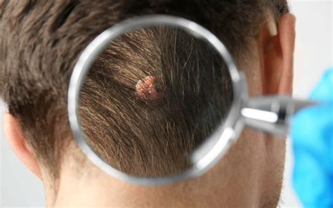 Moles on Scalp – Causes and Treatments | Beverly Hills MD