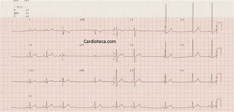 Curso ECG: Arritmia sinusal respiratoria