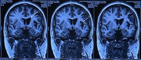 MRI of the brain: coronal FLAIR images showing dilated frontal horn of ...