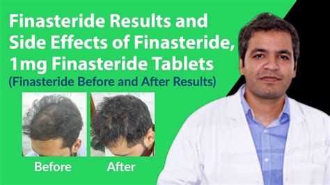 Finasteride Results and Finasteride Side Effects | Finasteride 1mg ...