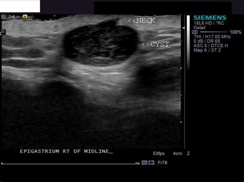 Ultrasound imaging: Ultrasound study of Sebaceous cyst: