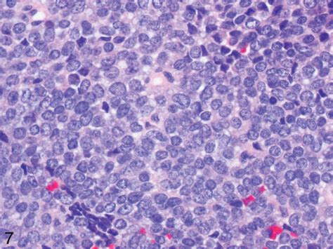 Ewing Sarcoma Histology