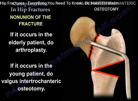 Hip Fracture complications — OrthopaedicPrinciples.com