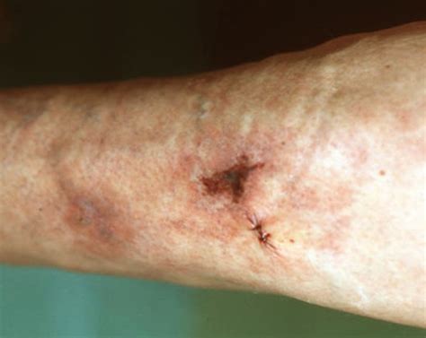 Calciphylaxis - Pictures, Symptoms, Diagnosis, Treatment, Causes | hubpages