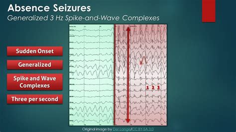 EEG INTERPRETATION