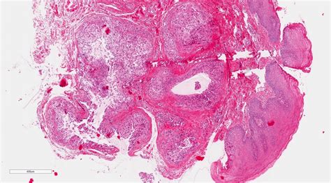 Mucocele Histology