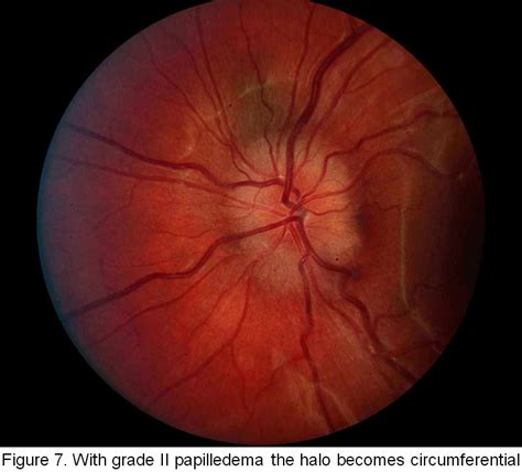 Papilledema Grades. EyeRounds.org - Ophthalmology - The University of Iowa