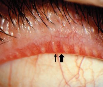 Meibomian Gland Dysfunction (MGD) | Atasca Eye Center