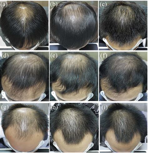 Finasteride Results: Timeline, Photos, Before & After