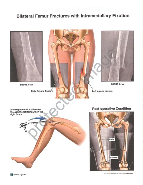 Patient Falls, Suffers Bilateral Leg Fractures and Dies, Nursing Home ...