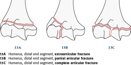 Distal Humerus Fracture Classification