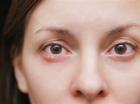 What Causes Styes and How to Avoid Them - Valley Eyecare