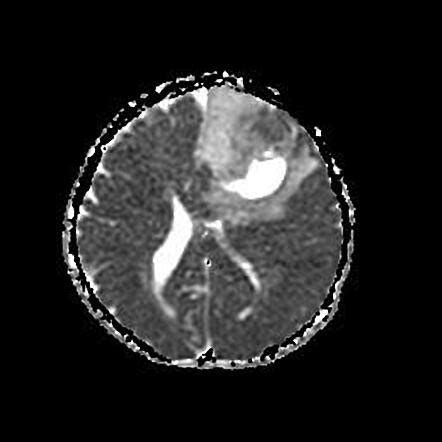 Pleomorphic xanthoastrocytoma | Image | Radiopaedia.org