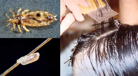 The Myths & Facts of Head Lice | Announce | University of Nebraska-Lincoln