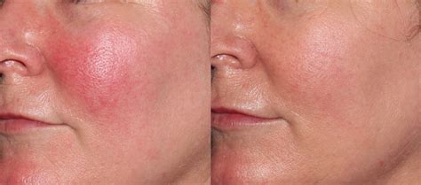 Rosacea Treatments Laser And Light Therapies: Experience Intense Dye ...