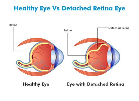 Warning Signs, Symptoms & Treatment | Retinal Detachment