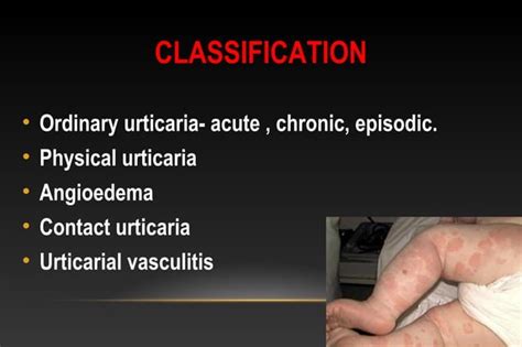 Urticaria | PPT