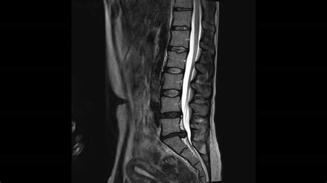 mri herniated disc L5-S1.m4v - YouTube