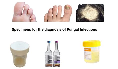 Sample Collections for Lab Diagnosis of Fungal Infections • Microbe Online