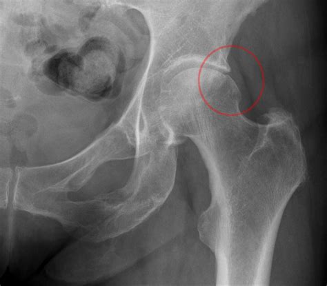 Things You Should Know About Hip Pain due to Hip Impingement and Your X ...