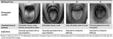 Airway Assessment • LITFL Medical Blog • CCC Airway