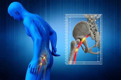 5 Methods for Sciatic Nerve Pain Relief