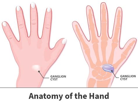 Ganglion Cyst Wrist Treatment| Florida Orthopaedic Institute