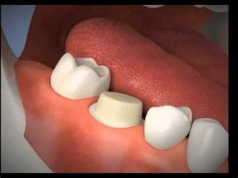 Porcelain Crown Procedure - YouTube