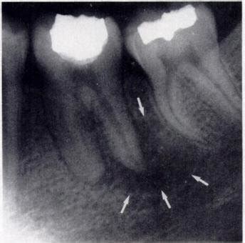 -Periapical abscess. lntraoral radiograph shows mandibular molar with ...