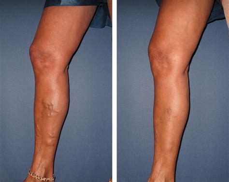 facial-vein-treatment-before-after | EZ Veins Orange County | Ca Vein ...