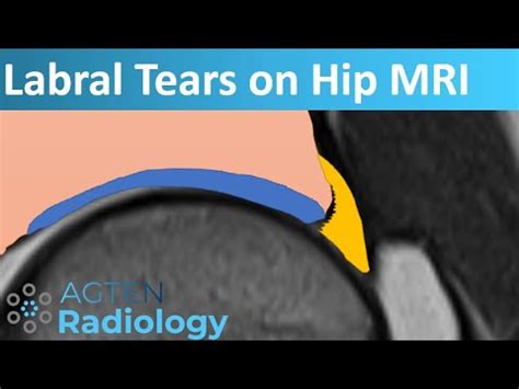 Labral Tears on Hip MRI - YouTube