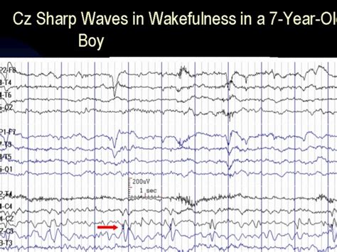 Abnormal EEG patterns