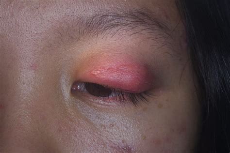 Cellulitis of the Eye (Orbital Cellulitis) – NVISION