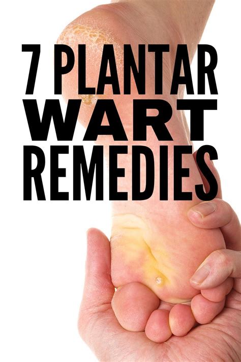 Home Remedies that Work: 7 Natural Treatments for Plantar Warts in 2021 ...