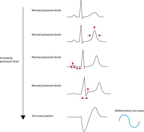 Hypokalemia Hyperkalemia Ecg