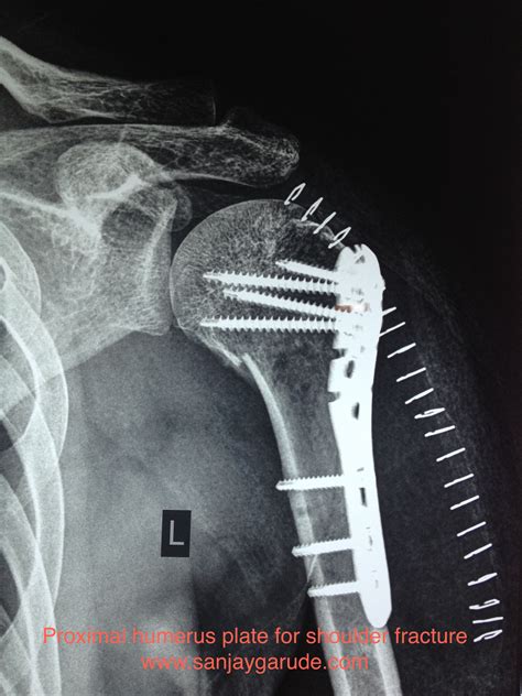 Shoulder Fractures | Dr. Sanjay Garude