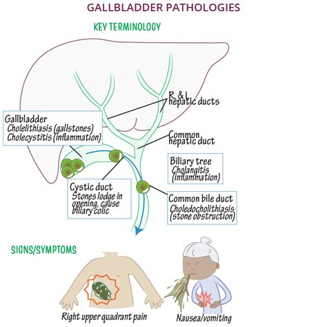 Clinical Pathology Glossary: Gallbladder Pathologies | ditki medical ...