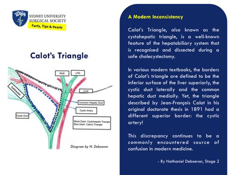 Calot’s Triangle: A Modern Inconsistency | SUSS