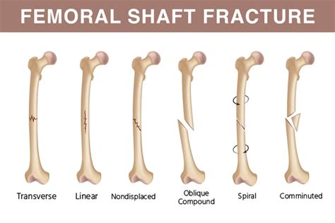 ORIF Compression Plating For Simple, Transverse, Middle 1/3, 58% OFF