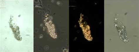 Urine Sediment of the Month: All About Those Oval Fat Bodies - Renal ...